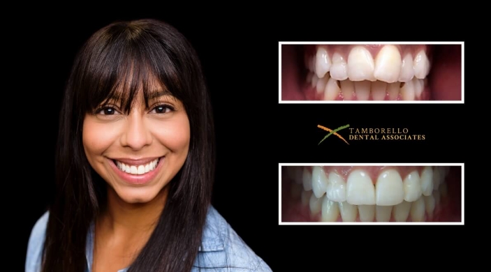 Woman with beautiful smile next to closeup of teeth before and after dentistry